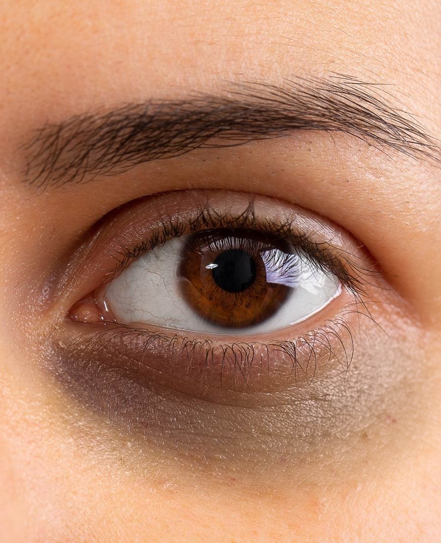 Under-Eye Dark Circle & Tear Trough Care